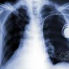 ​Основна інформація про хворобу — рак легень та як від нього вберегтися?