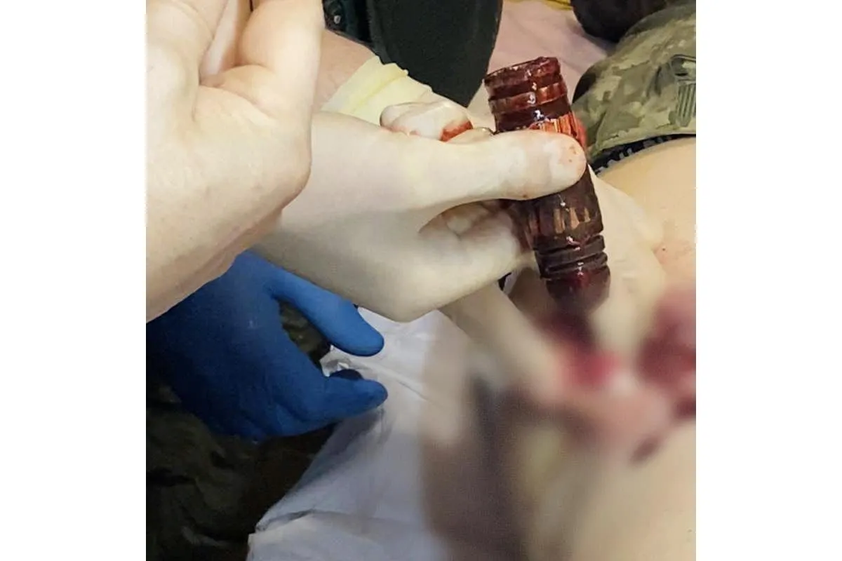 Командування Медичних сил ЗСУ повідомило про успішне вилучення бойової частини гранати типу ВОГ з тіла пораненого