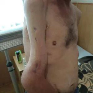 ​Жахливі кадри: так виглядає рука захисника Азовсталі після поранення та 4 місяців російського полону
