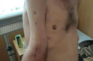 Жахливі кадри: так виглядає рука захисника Азовсталі після поранення та 4 місяців російського полону