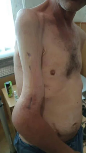 ​Жахливі кадри: так виглядає рука захисника Азовсталі після поранення та 4 місяців російського полону