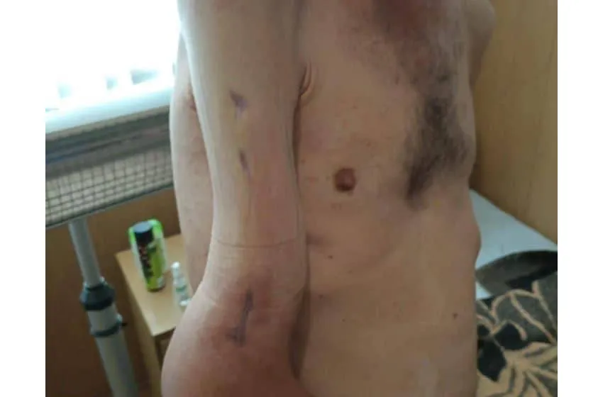 Жахливі кадри: так виглядає рука захисника Азовсталі після поранення та 4 місяців російського полону